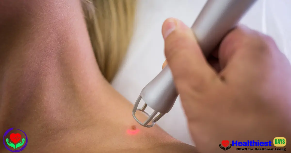 Hyperpigmentation Laser Treatment in the USA: Costs, Safety & Best Results (healthiestdays})