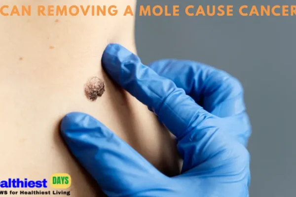 Can Removing a Mole Cause Cancer? Myths, Facts, and Expert Advice 2025 Can Removing a Mole Cause Cancer