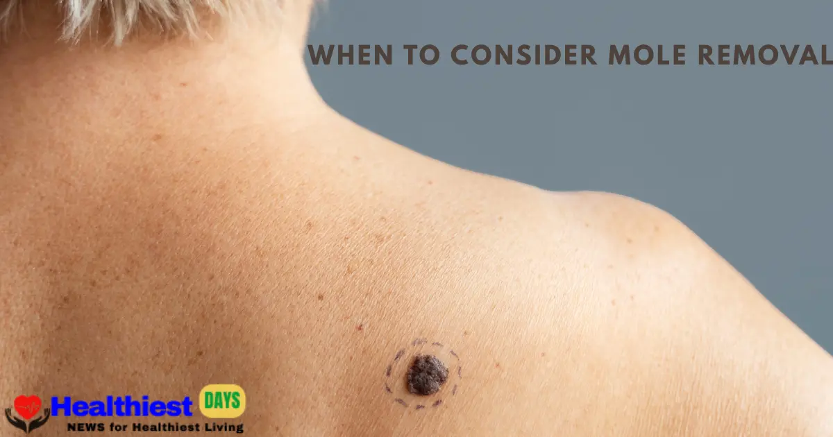 Can Removing a Mole Cause Cancer, When to Consider Mole Removal