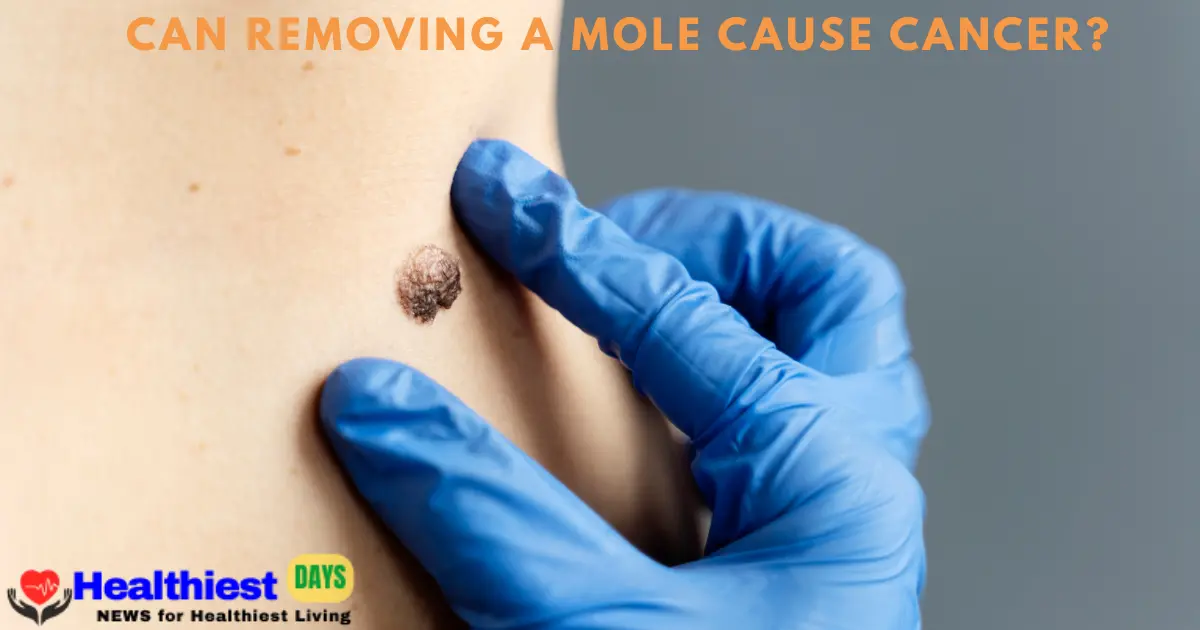 Can Removing a Mole Cause Cancer